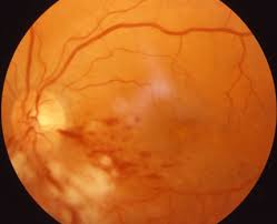treatment and symptoms of detached retina